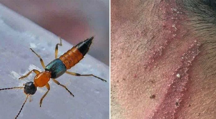 झापामा ‘नाइरोबी फ्लाइ’का सङ्क्रमित भेटिए ।