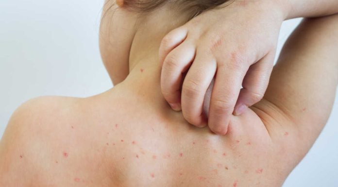 क्लाफाँटाका दुई बालकमा दादुरा–रुबेला